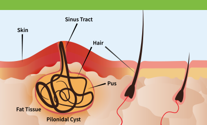 The Definitive Guide to Pilonidal Abscess - Evergreen Surgical Pilonidal  Clinic