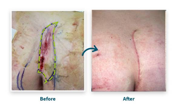 Revisional-Pre-1-Before-After