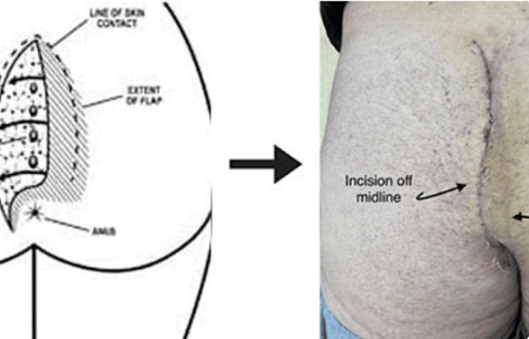 The Data Mounts: 261 Cleft-lifts for Complex Pilonidal Disease and Excisional Failures