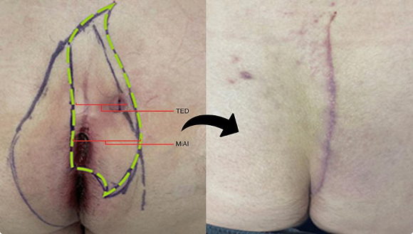 Figure 3 : Wide index cleft-lift