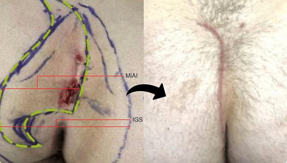 Figure 4 : Index cleft-lift in the deep cleft