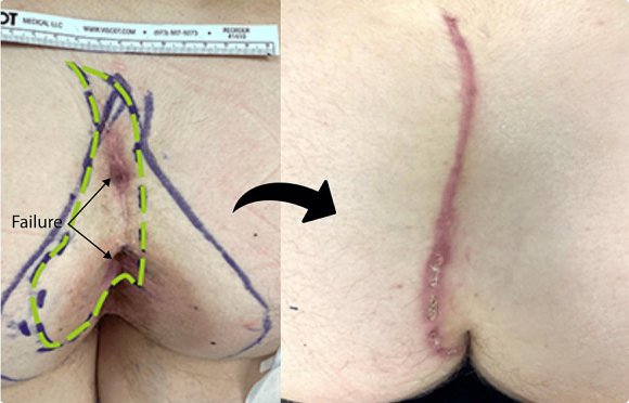 Figure 5 : Revision of a failed cleft-lift