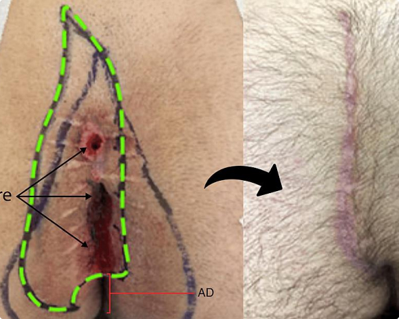 Figure 8 : Low revisional cleft-lift